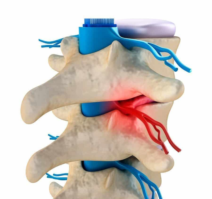 spinal cord injury lawyer